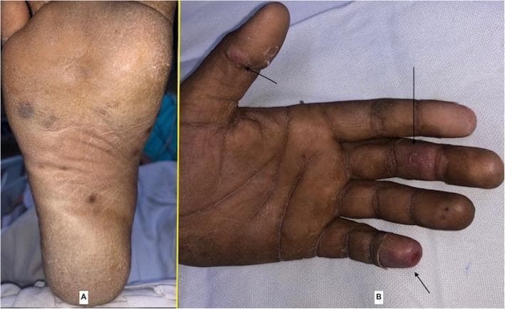 This clinical photograph consists of two panels illustrating peripheral cutaneous manifestations of infective endocarditis (IE). Panel A shows the plantar surface (sole) of a foot featuring several Janeway lesions, which appear as small, non-tender, erythematous to hemorrhagic macules with irregular borders. Panel B displays the palmar surface and digits of a hand, where black arrows indicate Osler nodes. These appear as small, tender, raised, reddish-purple nodules located on the distal pulp of the thumb and the middle phalanx of the ring finger. The educational focus of the image is to differentiate between the flat, microabscess-related Janeway lesions and the raised, immunologically mediated Osler nodes. These classic physical findings serve as important clinical clues for a diagnosis of subacute or acute bacterial endocarditis. The presentation is highly relevant for medical students and clinicians specializing in infectious diseases, cardiology, and dermatology.