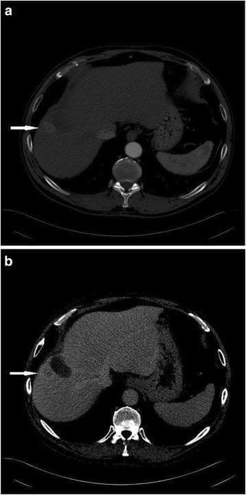 Two-panel axial CT scan of the abdomen in the arterial (a) and venous (b) phases, demonstrating a post-radiofrequency ablation (RFA) assessment in a patient with cirrhosis. Image (a) shows a hyperattenuating, arterial-enhancing nodule located at the periphery of a hypodense, well-defined rounded ablation zone in the liver. Image (b) shows the same nodule in the portal venous phase, characterized by contrast 'washout,' where the nodule becomes hypoattenuating relative to the surrounding liver parenchyma. The ablation zone itself remains non-enhancing and relatively homogeneous in both phases. This dynamic contrast enhancement pattern—arterial hyperenhancement followed by venous washout—is the hallmark of recurrent or residual hepatocellular carcinoma (HCC). The image illustrates the clinical application of CT in monitoring locoregional therapy response and identifying residual tumor at the treatment margins.