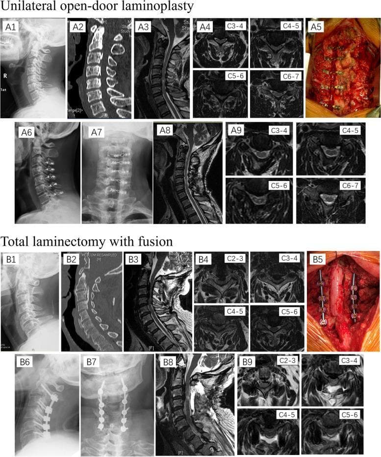 This composite educational image illustrates two surgical techniques for treating multi-segmental cervical canal stenosis: unilateral open-door laminoplasty (A1-A9) and total laminectomy with fusion (B1-B9). The visual content includes preoperative, intraoperative, and postoperative stages across multiple modalities. Preoperative X-rays (A1-2, B1-2), sagittal CT scans, and T2-weighted MRI (A3-4, B3-4) demonstrate multi-level spinal cord compression and ossification of the posterior longitudinal ligament (OPLL). Intraoperative clinical photographs (A5, B5) show the posterior approach: A5 depicts the hinged lamina stabilized with mini-plates and screws, while B5 shows total removal of the laminae with pedicle screw and rod instrumentation. Postoperative lateral and anteroposterior X-rays (A6-7, B6-7) verify hardware placement from C3 to C7. Postoperative MRI (A8-9, B8-9) highlights the decompression of the spinal cord and expansion of the vertebral canal. The comparison serves to distinguish between motion-preserving (laminoplasty) and stabilizing (laminectomy with fusion) procedures for cervical myelopathy.