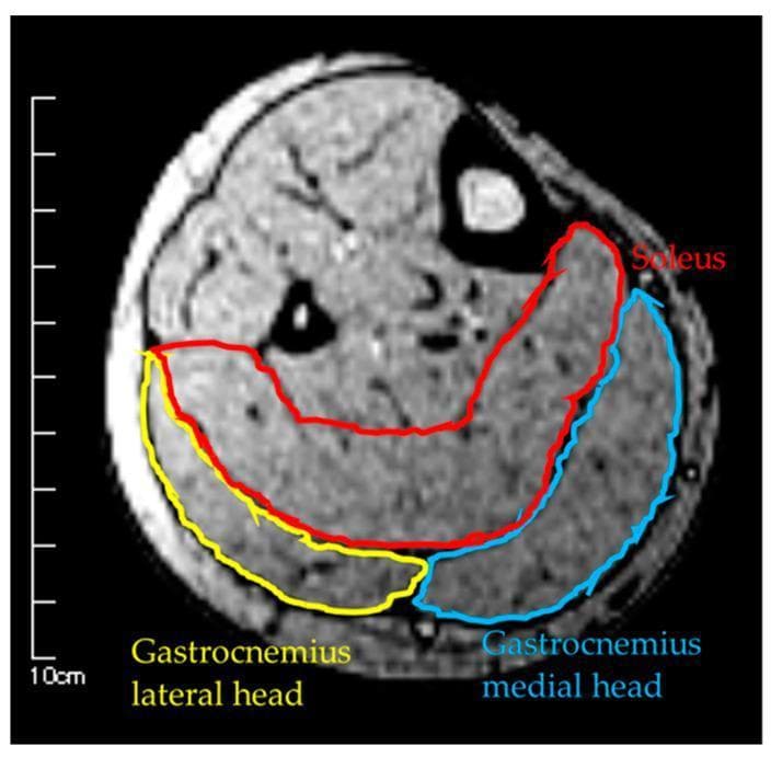 This diagnostic image is an axial T1-weighted MRI cross-section of the human lower leg, demonstrating the musculoskeletal anatomy of the posterior compartment. The primary focus is the triceps surae muscle group, with color-coded overlays identifying specific muscle boundaries for cross-sectional area (CSA) measurement. The Soleus (SOL) is delineated in red, showing a broad, crescent-shaped morphology that occupies the deep portion of the posterior compartment. Situated superficially to the soleus are the two heads of the gastrocnemius: the Gastrocnemius Medial Head (GM), outlined in blue, and the Gastrocnemius Lateral Head (GL), outlined in yellow. The image clearly shows the fascial planes separating these muscles and their relative positions to the tibia and fibula bones. This visual serves as an educational tool for identifying lower limb anatomy and understanding diagnostic imaging techniques used to quantify muscle mass, volume, and atrophy in clinical research or sports medicine.