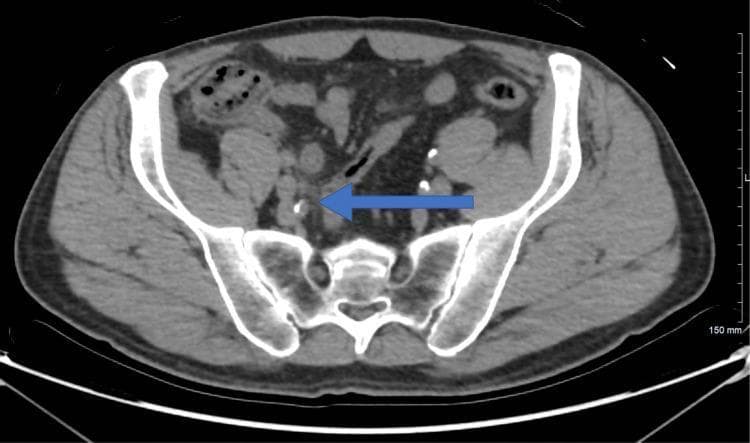 An axial non-contrast-enhanced computed tomography (CT) scan of the lower abdomen and pelvis at the level of the iliac wings. The diagnostic image shows cross-sectional anatomy including the sacrum, iliac bones, and abdominal wall musculature. A prominent blue arrow indicates the location of the appendix in the right lower quadrant, which appears mildly thickened with subtle surrounding fat stranding, suggestive of early or resolving inflammatory changes (appendicitis). Multiple high-attenuation (radiopaque) foci are visible within the pelvic cavity, consistent with documented renal calculi or vascular calcifications. The surrounding mesenteric fat and bowel loops are visible, providing a baseline for assessing intra-abdominal inflammation. This imaging is utilized in surgical and radiological education to demonstrate the CT presentation of suspected appendiceal pathology and its anatomical relationships within the pelvic inlet.