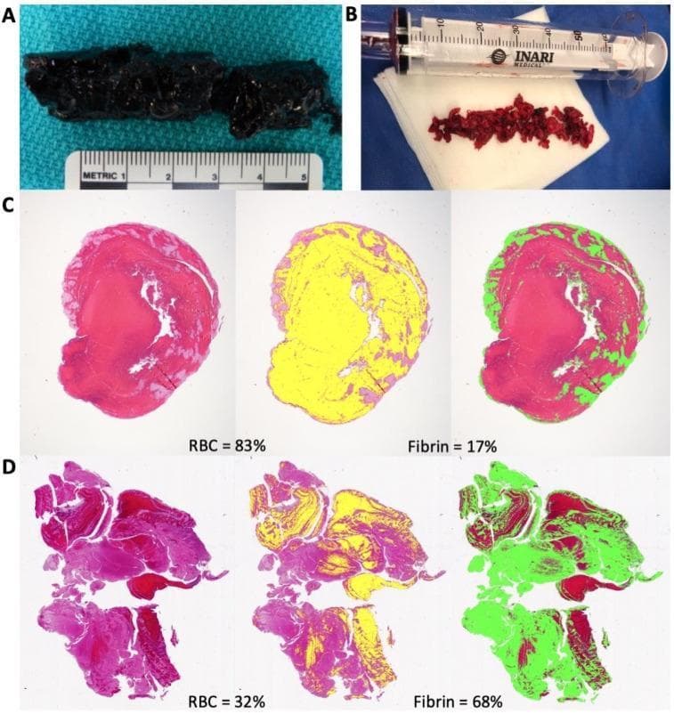 A multi-panel medical image comparing the macroscopic and microscopic characteristics of deep vein thrombosis (DVT) retrieved via mechanical thrombectomy. Panels A and B are clinical photographs of extracted thrombi: A shows a cohesive, dark, approximately 5cm long 'red' clot from an acute case, while B shows fragmented, lighter-red 'white' clot segments from a more chronic case. Panels C and D provide histological and quantitative analysis of these thrombi using color-coded mapping. Panel C demonstrates an acute thrombus composed of 83% erythrocytes (yellow mask) with 17% fibrin (green mask) localized primarily to the periphery. Panel D illustrates a more chronic, organized thrombus with a significantly higher fibrin content (68% in green) distributed throughout the segment and a lower erythrocyte concentration (32% in yellow). This visual comparison highlights the evolution of clot morphology from erythrocyte-rich acute stages to fibrin-rich chronic stages, which correlates with mechanical retrieval success and clinical resolution.