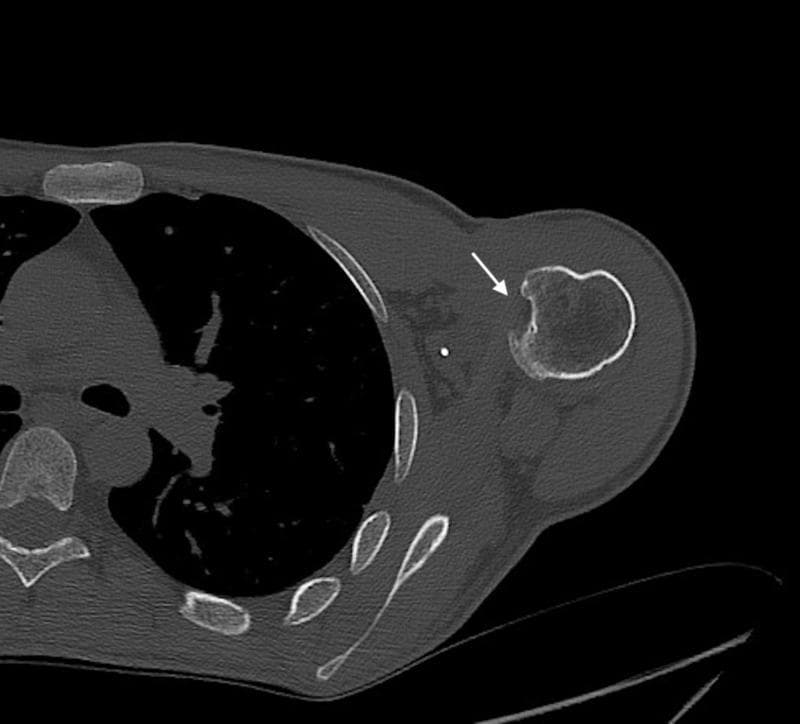 This diagnostic axial CT image of the shoulder demonstrates a posterior glenohumeral dislocation or subluxation in a 39-year-old patient. The humeral head is displaced posteroinferiorly relative to the glenoid fossa. A prominent impaction fracture is visible on the anteromedial aspect of the humeral head (indicated by the white arrow), characteristic of a reverse Hill-Sachs lesion. This type of bony defect typically occurs when the anterior humeral head impacts against the posterior glenoid rim during a posterior dislocation event. Additionally, small radiopaque hyperdensities are visible in the anterior periarticular soft tissues, representing metallic suture anchors from a prior McLaughlin-type remplissage surgical procedure. The posterior glenoid rim appears relatively well-preserved, without evidence of a significant bony Bankart lesion. This image serves as a clinical example of chronic posterior shoulder instability and the associated characteristic secondary bony changes often seen in patients with repetitive trauma or seizure-related dislocations.