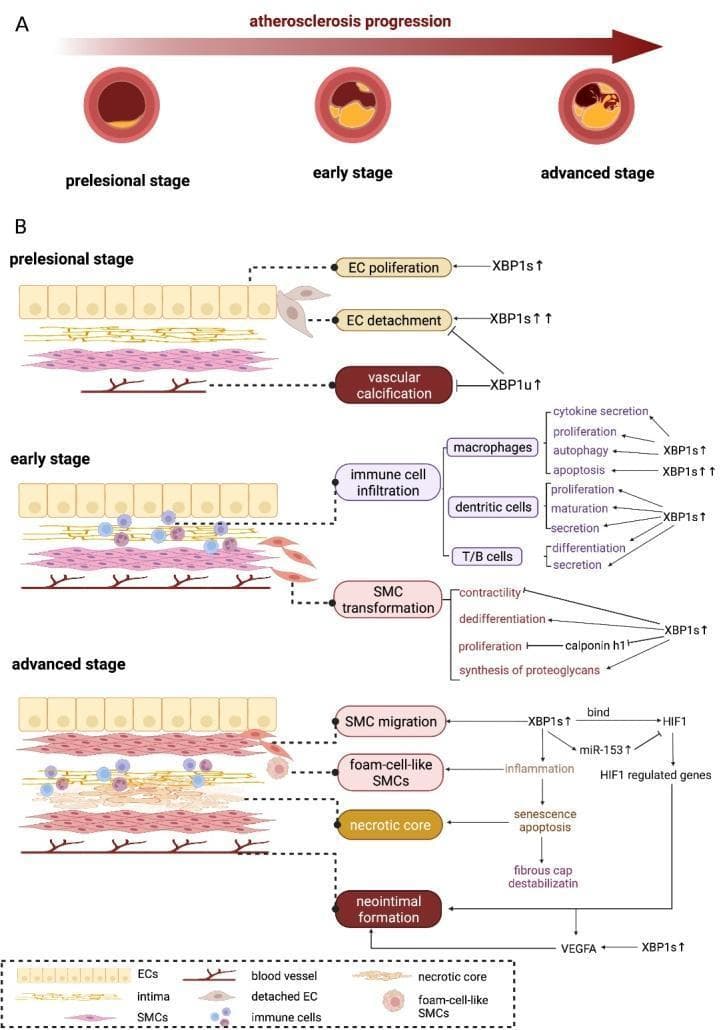 This medical pathophysiology diagram illustrates the progression of atherosclerosis across three stagesβprelesional, early, and advancedβfocusing on the regulatory role of X-box binding protein 1 (XBP1). Section A presents cross-sections of an artery showing luminal narrowing and plaque accumulation. Section B provides a high-resolution view of the vessel wall layers, including endothelial cells (ECs), the intima, and smooth muscle cells (SMCs). In the prelesional stage, XBP1 isoforms modulate EC proliferation and detachment. The early stage is characterized by immune cell infiltration (macrophages, dendritic cells, T/B cells) and SMC transformation, where XBP1s influences contractility, dedifferentiation, and proteoglycan synthesis. The advanced stage depicts significant pathology, including SMC migration, the formation of foam-cell-like SMCs, a necrotic core, and neointimal formation. Molecular pathways highlight XBP1s interacting with HIF1 and miR-153 to regulate angiogenesis (VEGFA) and fibrous cap destabilization via senescence and apoptosis. This infographic serves as a cardiovascular research and educational tool for understanding the cellular and molecular mechanisms of atherogenesis.