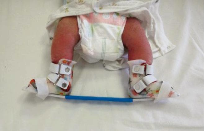 This clinical photograph displays a foot abduction orthosis (FAO), also known as a Denis Browne bar, applied to an infant following the correction phase of the Ponseti method for congenital talipes equinovarus (clubfoot). The device consists of two open-toed, high-top shoes with patterned rigid shells, secured around the infant's feet and ankles using multiple white leather straps with buckle closures. The shoes are mounted onto a horizontal blue abduction bar, which maintains the feet in a fixed position of external rotation and abduction. Asymmetrical positioning is visible, consistent with clinical protocols where the affected foot is abducted to 60–70 degrees while a non-affected or 'normal' side is held at a lower angle of 30–40 degrees. This orthotic intervention is critical in pediatric orthopedics to prevent relapse of the clubfoot deformity by stretching the medial soft tissues and maintaining the corrected alignment of the tarsal bones. The photograph illustrates a common post-corrective maintenance phase in clubfoot management.