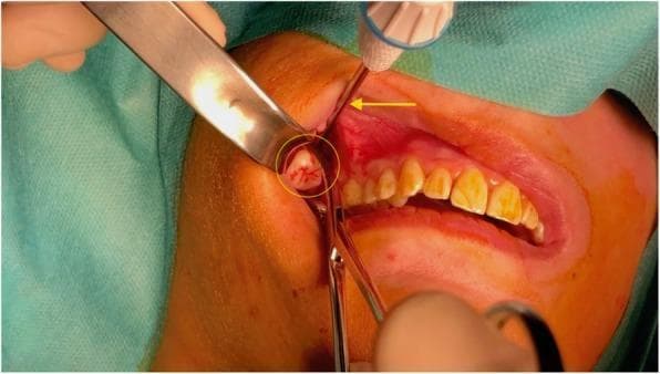 Clinical photograph of an intraoral surgical procedure for the retrieval of a displaced maxillary third molar (wisdom tooth). The surgical field shows the right posterior superior buccal sulcus of a patient under anesthesia. A yellow circle highlights the crown of the displaced tooth being extracted from the soft tissue. A yellow arrow points to a 12 Gauge bone trocar inserted through a small incision in the buccal sulcus to provide cranial stabilization and support. Surgical instrumentation is visible, including a metal retractor reflecting the cheek for visualization and a pair of Kelly forceps grasping the tooth for retrieval. The surrounding gingival tissue shows expected perioperative erythema and inflammation. The adjacent maxillary teeth are visible, demonstrating moderate intrinsic staining. This image illustrates a combined radiologic-surgical approach for managing teeth displaced into deep facial spaces like the infratemporal fossa.