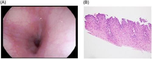 A dual-panel comparison exhibiting normal esophageal findings. Panel (A) is a clinical photograph from an esophagogastroduodenoscopy (EGD) showing a healthy esophageal lumen. The mucosa is characterized by a smooth, pink, and glistening surface without evidence of mucosal rings, linear furrows, white exudates, or strictures, indicating the absence of typical eosinophilic or lymphocytic esophagitis features. Panel (B) is a diagnostic histology image (Hematoxylin and Eosin stain) of an esophageal biopsy at high power. It demonstrates normal stratified squamous epithelium with organized cellular maturation. The basal cell layer appears healthy without hyperplasia, and the lamina propria is free of significant inflammatory cell infiltration, specifically lacking eosinophils or intraepithelial lymphocytes. Together, these images serve as a baseline for normal esophageal anatomy and histology in a pediatric gastroenterology context, often used to confirm mucosal healing following treatment for conditions such as chemical or thermal injury.