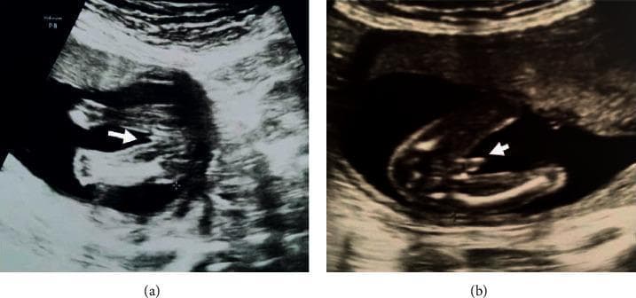 This diagnostic imaging set consists of two grayscale fetal ultrasound images in the transverse plane, focusing on the external genitalia during the second trimester (approximately 18–20 weeks).
Image (a) displays the characteristic sonographic appearance of a female fetus. An arrowhead points to a series of parallel, hyperechoic linear structures representing the labia majora and labia minora, often referred to as the 'hamburger sign' in clinical practice.
Image (b) displays the sonographic appearance of a male fetus. The arrowhead indicates a distinct dome-shaped structure representing the phallus and scrotum. A central, longitudinal echogenic line is visible at the base of the structure, which is a characteristic finding for male genital development at this gestational age.
These images serve as educational examples for fetal sex determination during routine prenatal screening. Key visual indicators highlighted include the presence of parallel lines (female) versus a protruding, dome-shaped morphologic structure (male). The surrounding environment shows typical hypoechoic amniotic fluid and varying echogenicity of fetal soft tissue.