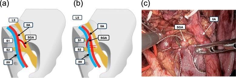 This composite image illustrates the anatomical variations in the spatial relationship between the superior gluteal artery (SGA) and the internal iliac vein (IIV). The image consists of two schematic diagrams (a and b) and one laparoscopic photograph (c). Schematic (a) depicts the SGA (red) running dorsal and lateral to the IIV (blue) as it branches from the internal iliac artery (IIA). Schematic (b) demonstrates an anatomical variation where the SGA runs dorsal but medial to the IIV. In both diagrams, the relationship to the sacral nerve plexus (L5, S1, S2) is shown, with the SGA typically passing between L5 and S1. Panel (c) is a clinical photograph from a right-sided laparoscopic lateral lymph node dissection, confirming the medial SGA variation shown in diagram (b). Key structures are labeled, including the IIA, SGA, and the IIV (marked with an asterisk and dashed white outlines). This material serves as a surgical anatomy reference for identifying neurovascular landmarks in the pelvic cavity.