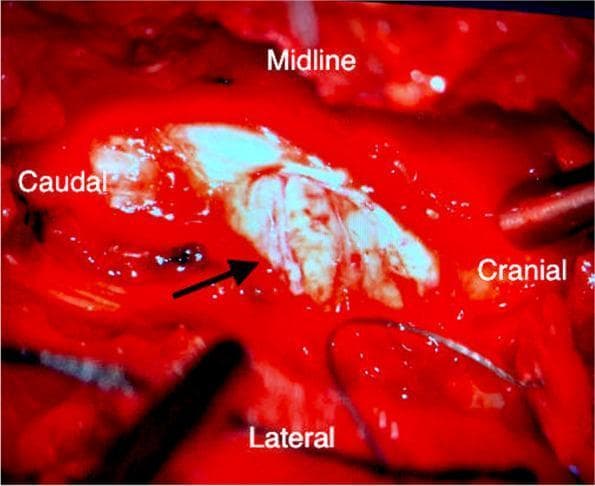 This clinical intraoperative photograph shows an exposed thoracic spinal cord under surgical magnification following a T2-T3 laminectomy. The image illustrates a traumatic spinal cord hemisection resulting from penetrating trauma. A black arrow points to the primary site of injury where the right lateral aspect of the spinal cord is visibly severed and disrupted. The exposed cord tissue appears pale-white against the background of bright red, hyperemic surgical margins and contused dura mater. Labels indicate the anatomical orientation: 'Cranial' (right), 'Caudal' (left), 'Midline' (top), and 'Lateral' (bottom). The dura mater at both the cranial and caudal poles of the surgical field shows significant contusion and hemorrhagic discoloration. This visual serves as a critical educational example of acute mechanical spinal cord disruption and is relevant for neurosurgical training regarding the assessment of Brown-Séquard syndrome-related injuries and subsequent micro-surgical repair techniques.