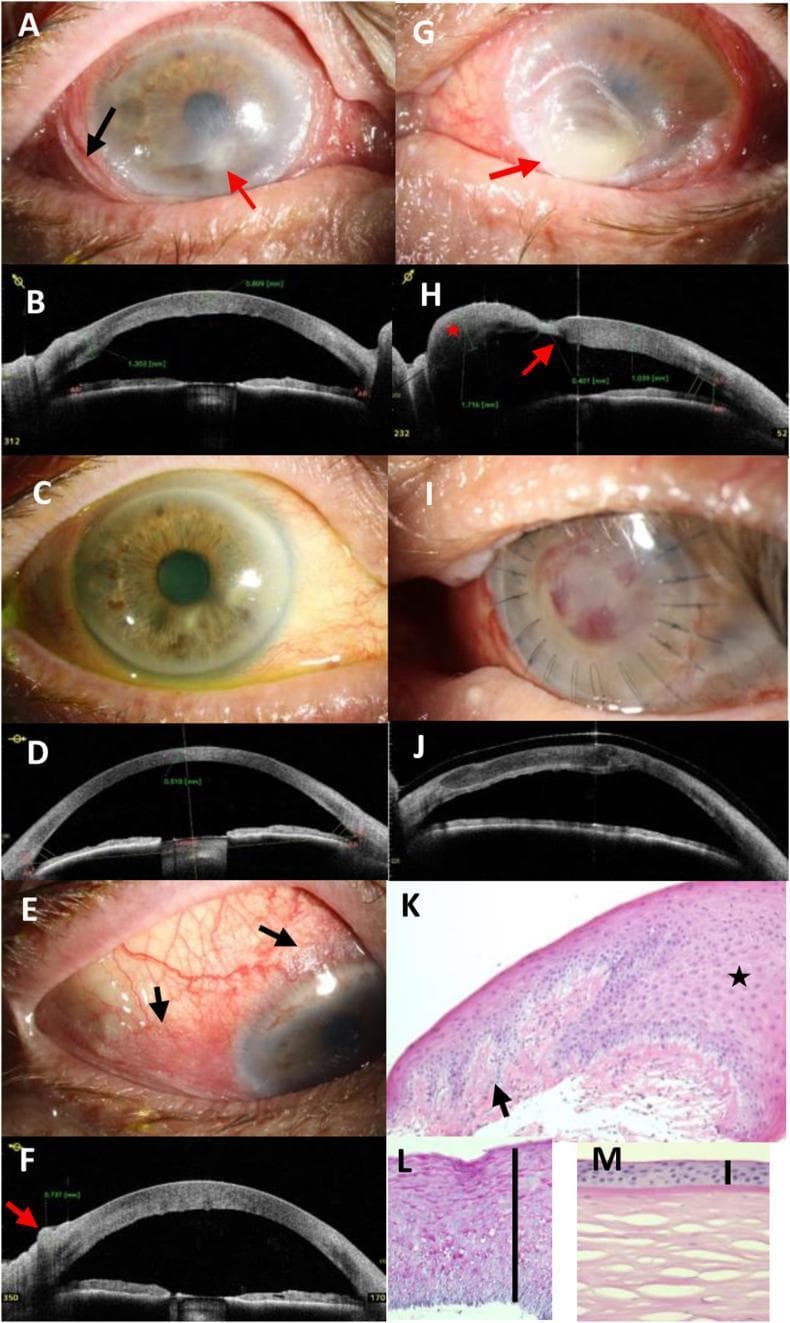 This composite figure illustrates the clinical and diagnostic progression of severe xerophthalmia and keratomalacia secondary to vitamin A deficiency in a 70-year-old male. Panels A, E, and G show clinical photographs highlighting characteristic Bitot's spots (foamy keratinized conjunctival plaques), corneal stromal infiltrates, and advanced keratomalacia with focal bulging (staphyloma formation). Panels B, D, F, H, and J utilize Anterior Segment Optical Coherence Tomography (AS-OCT) to quantify pathology, revealing conjunctival thickening (up to 737 μm), corneal stromal edema (1039 μm), and focal thinning (401 μm). Post-treatment panels (C, D, I, J) demonstrate clinical resolution after vitamin A supplementation and tectonic lamellar keratoplasty, with AS-OCT confirming successful graft adaptation. Histopathological sections (K, L) using HE and PAS stains contrast the diseased cornea against a normal control (M), showing massive epithelial hyperplasia (approximately 20 cell layers), focal keratinization, loss of Bowman's layer, and granular PAS-positive deposits, pathognomonic for squamous metaplasia in the setting of nutritional deficiency.