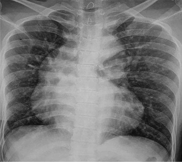 This diagnostic image is a posteroanterior (PA) chest X-ray demonstrating classic radiographic signs associated with cyanotic congenital heart disease, specifically Tetralogy of Fallot (TOF). The most prominent feature is the 'boot-shaped' heart (coeur en sabot), characterized by an upturned cardiac apex due to right ventricular hypertrophy and a concave pulmonary artery segment. The mediastinal shadow shows a significantly dilated ascending aorta, which is a common compensatory finding in TOF or pulmonary atresia. The lung fields appear remarkably clear, indicating decreased pulmonary vascular markings (oligemia) rather than pulmonary congestion, consistent with reduced pulmonary blood flow. This visual representation serves as a key educational tool for identifying the anatomical distortions caused by right-to-left shunting and right ventricular outflow tract obstruction in pediatric and adult congenital cardiology.