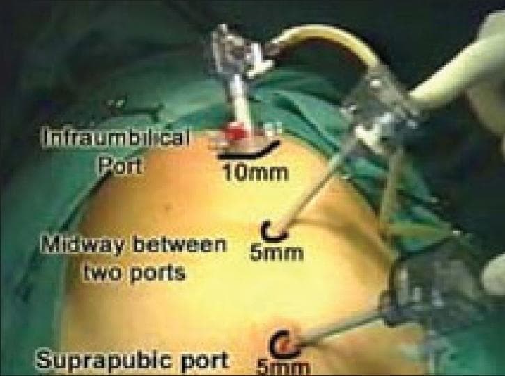 This clinical photograph illustrates the standard laparoscopic port placement for a Totally Extraperitoneal (TEP) inguinal hernia repair. The patient is positioned supine, with the abdomen draped in green surgical sheets. Three trocars are inserted along the midline into the preperitoneal space. The superior port is a 10-mm infraumbilical port, equipped with a valve mechanism and insufflation tubing, typically used for the 30-degree laparoscope. Positioned inferiorly in the midline are two working ports: a 5-mm port placed midway between the umbilical and pubic regions, and a 5-mm suprapubic port located approximately 2–3 cm above the pubic symphysis. The visual demonstrates the vertical triangulation required for instruments to reach the inguinal region. This configuration allows the surgeon to operate within the extraperitoneal plane without entering the peritoneal cavity, minimizing the risk of visceral injury and facilitating mesh placement over the direct, indirect, and femoral hernia sites.