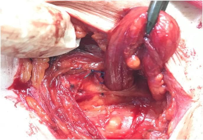 This clinical photograph captures an intraoperative view of an inguinal hernia repair, specifically demonstrating the 'double-breasting' technique of the External Oblique Aponeurosis (EOA). The surgical field shows exposed anatomical structures including the spermatic cord, which is being retracted superiorly and laterally by a surgical instrument (forceps) to reveal the underlying repair. The medial and lateral leaves of the EOA are visible; the lateral leaf is being sutured to overlap the medial leaf, effectively strengthening the posterior wall of the inguinal canal. Several blue, non-absorbable interrupted sutures (likely Prolene) are positioned in the center, approximating the fascial edges. The surrounding tissue includes striated muscle fibers, yellow adipose tissue (fat), and areas of surgical hemorrhage and serosanguinous fluid. This visual demonstrates the repositioning of the spermatic cord to a subcutaneous location as part of the canal's obliteration process to prevent hernia recurrence.