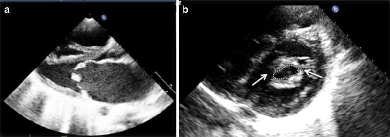 Two-panel diagnostic imaging featuring a 2D transthoracic echocardiogram (TTE) of severe mitral stenosis, typically associated with rheumatic heart disease. Panel (a) shows a parasternal long-axis view during diastole, highlighting significant thickening and increased echogenicity of the mitral valve leaflets. The anterior leaflet demonstrates characteristic 'doming' (hockey-stick deformity) with restricted excursion, indicating limited valve opening. Panel (b) presents a parasternal short-axis view at the level of the mitral valve orifice. White arrows point to commissural fusion, a hallmark of stenotic valvular pathology. The mitral valve area (MVA) is manually traced via planimetry (indicated by the dotted line), yielding a measurement of 0.73 cm², which falls into the category of severe stenosis (MVA < 1.0 cm²). These images demonstrate the classic morphology used in cardiology for assessing valvular narrowing, leaflet mobility, and subvalvular involvement to determine the clinical severity of mitral stenosis.