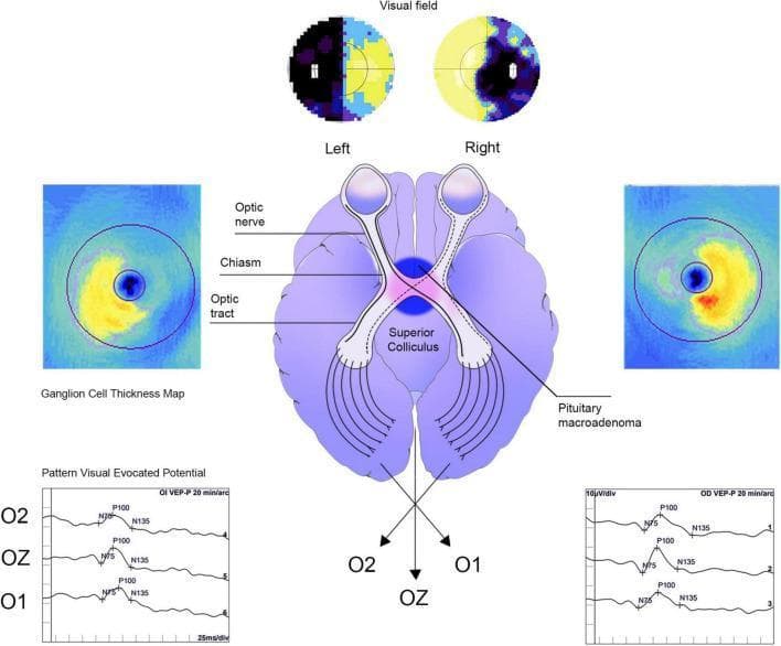 A multi-panel medical illustration demonstrating the neuro-ophthalmological effects of a pituitary macroadenoma on the visual pathways. The central anatomical diagram depicts a pituitary macroadenoma compressing the optic chiasm, specifically affecting the decussating nasal retinal fibers. Above this, visual field maps for the left and right eyes show a classic bitemporal hemianopia, characterized by significant peripheral field loss in both temporal regions. Flanking the central diagram are Optical Coherence Tomography (OCT) ganglion cell thickness maps, utilizing a color-coded heat scale (blue for thin, red/yellow for thick) to show macular ganglion cell complex (GCC) distribution, highlighting bi-nasal thinning relative to the vertical meridian. The bottom section displays Pattern Visual Evoked Potential (PVEP) waveforms for O2, OZ, and O1 electrodes, showing clinical markers like the P100 wave used to assess signal latency and amplitude. This infographic provides a comprehensive overview of how a chiasmal lesion translates into specific functional visual deficits, structural retinal changes, and electrophysiological delays, intended for medical education on sellar region tumors.