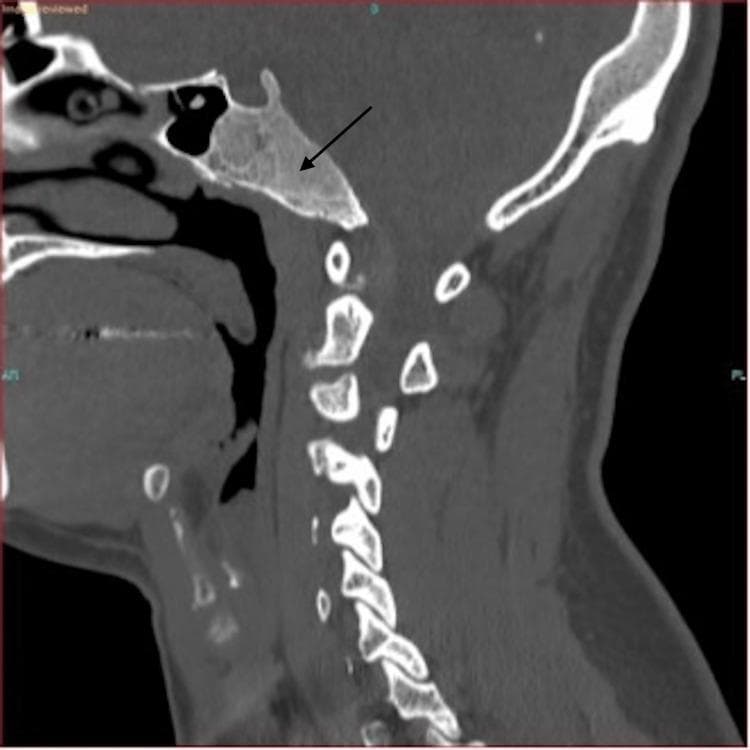 This diagnostic image is a non-contrast Computed Tomography (CT) scan of the skull base and cervical spine in a sagittal view. The focus is on a prominent, expansile lesion within the clivus, indicated by a black arrow. The lesion demonstrates a characteristic 'ground-glass' matrix, which is a hallmark radiologic feature of fibrous dysplasia. The mass measures approximately 3.8 cm (AP) by 2.2 cm (craniocaudal) and shows thinning of the overlying cortical bone without evidence of aggressive periosteal reaction or frank destruction. Anatomical landmarks include the sphenoid sinus anterior to the lesion and the cervical vertebrae (C1-C7) posteriorly. The clinical significance of this finding is the identification of benign fibrous dysplasia of the skull base, differentiating it from more aggressive clival pathologies such as chordoma or metastatic disease. The image is intended for medical education in radiology and neurosurgery, focusing on bone pathology and diagnostic imaging of the skull base.