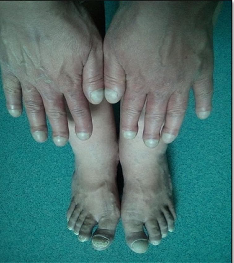 This clinical photograph displays the hands and feet of a patient, demonstrating classic physical signs of chronic hypoxemia. Both the fingers and toes exhibit significant digital clubbing (Hippocratic fingers), characterized by a bulbous, drumstick-like enlargement of the distal phalanges and increased longitudinal and transverse curvature of the nail plates. There is a noticeable loss of the normal Lovibond angle at the nail bed. Additionally, central cyanosis is evident as a dusky, bluish-purple discoloration of the nail beds and surrounding distal integument. These findings are clinically significant as classic markers for congenital cyanotic heart disease, such as Tetralogy of Fallot, or advanced pulmonary disease. The image serves as an educational reference for identifying cardinal signs of systemic oxygen desaturation during a physical examination.