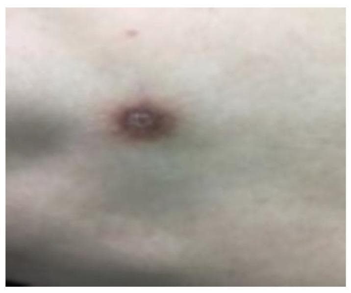 This clinical photograph displays a solitary skin lesion consistent with a dermatofibroma (DF) on a patient's skin. The lesion is a well-defined, circular, hyperkeratotic nodule measuring approximately 1 cm in diameter. It exhibits a distinct yellow-brown surface coloration and is clearly demarcated from the surrounding integument. The visual presentation highlights the characteristic firm, slow-growing nature of these benign fibrous histiocytomas, which frequently present as solitary papules or nodules. This image serves as an educational reference for dermatology students and clinicians to recognize the common clinical morphology of dermatofibromas, distinguishing them from other pigmented or nodular skin conditions through their specific texture, color, and border definition.