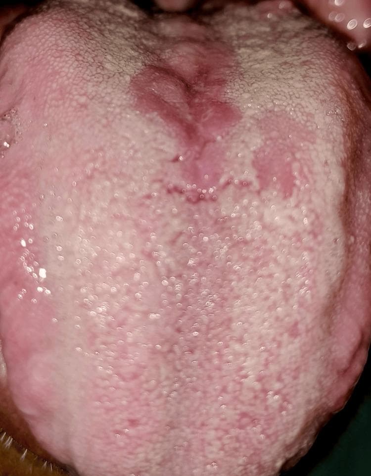 This clinical intraoral photograph displays the dorsal surface of a human tongue, showcasing a characteristic presentation of median rhomboid glossitis (MRG). The primary finding is a well-circumscribed, erythematous, rhomboid-shaped area of depapillation located in the midline of the posterior dorsal tongue, immediately anterior to the circumvallate papillae. The lesion appears as a smooth, slightly elevated, and beefy red patch that contrasts with the surrounding light-pink tissue covered in normal filiform papillae. There are no signs of ulceration, fissuring, or exudate within the lesion. The surrounding lingual mucosa shows a mild white coating, possibly representing physiological debris or minor keratosis, while the erythematous patch lacks this coating due to the loss of papillae. This visual is a classic representation of a benign inflammatory or developmental condition often associated with chronic candidal infection, used in dental and medical education to differentiate between geographic tongue, candidiasis, and oral malignancies.
