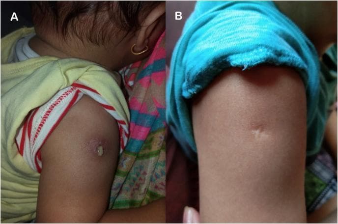 Clinical photograph comparison in a pediatric patient showing the evolution of a BCG (Bacillus Calmette-Guérin) vaccine inoculation site on the right deltoid. Figure A demonstrates a local adverse reaction characterized by an erythematous, indurated area with active purulent discharge emanating from a central pustule. This represents the acute inflammatory phase or a localized abscess. Figure B shows the same anatomical site two months later, following wound management. The inflammatory features—erythema and discharge—have completely resolved, replaced by a characteristic, small, hypopigmented atrophic scar. The images illustrate the progression from an active localized complication to a healed BCG scar, providing a visual reference for clinical monitoring of vaccination sites.