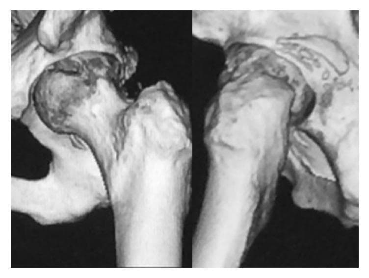 This diagnostic image consists of two 3D-reconstructed CT scan views of a left hip joint following a manual reduction procedure. The imaging depicts the anatomical relationship between the proximal femur and the pelvis. Key findings include a fracture of the posterior wall of the acetabulum with a visible bone fragment. Furthermore, an impaction injury or depression is present on the posterior-superior aspect of the femoral head, characteristic of damage sustained during a posterior hip dislocation. The reconstruction allows for assessment of joint congruity and the integrity of the acetabular rim. The clinical significance of these findings relates to orthopedic stability, where the combination of a posterior wall defect and femoral head impaction (analogous to a Hill-Sachs lesion in the shoulder) increases the risk of recurrent dislocation. This material is suitable for orthopedic surgical planning and educational review of traumatic hip injuries.