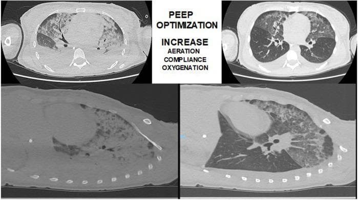 This diagnostic image displays four panels of thoracic computed tomography (CT) scans in axial and sagittal views, illustrating lung recruitment and Positive End-Expiratory Pressure (PEEP) titration in a patient with Acute Respiratory Distress Syndrome (ARDS). The left-side panels show initial scans with extensive bilateral opacities, including heterogeneous ground-glass appearance and dense consolidation in the dependent lung regions, characteristic of pulmonary edema and alveolar collapse. The right-side panels demonstrate the clinical effect of PEEP optimization, showing significant recruitment of lung parenchyma. This is evidenced by increased aeration and a reduction in consolidated areas, though residual ground-glass opacities and air bronchograms remain visible in the posterior segments. The center text highlights the educational goals of PEEP titration: increasing aeration, compliance, and oxygenation. The image serves as a comparison chart between baseline respiratory failure and the post-intervention state, demonstrating the use of CT imaging for real-time monitoring of ventilatory strategies in critical care settings.