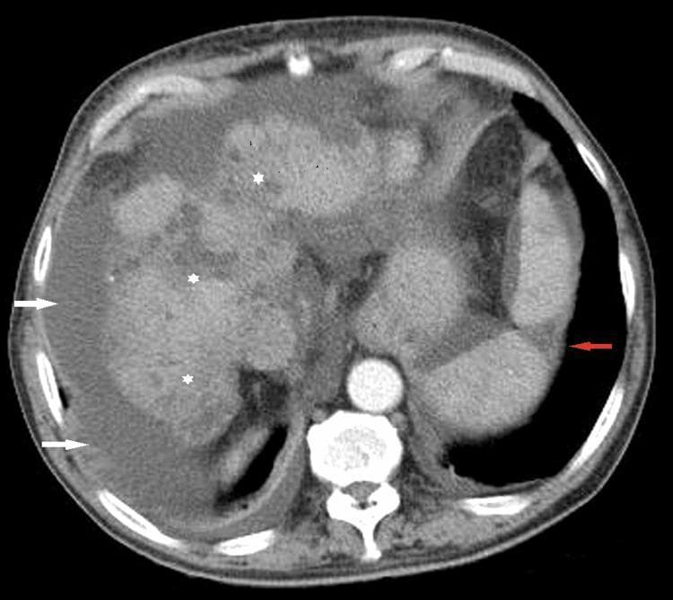 This diagnostic image is an axial contrast-enhanced CT scan of the upper abdomen, demonstrating multiple hallmarks of chronic liver disease and portal hypertension. The liver exhibits classic features of cirrhosis, including prominent surface nodularity and parenchymal heterogeneity (indicated by white asterisks), which give the organ an irregular, bumpy contour. Significant ascites is present, visualized as low-attenuation fluid collections in the perihepatic and perisplenic spaces (highlighted by white arrows). In the spleen, a well-defined, wedge-shaped hypodense area is observed (red arrow), characteristic of a splenic infarct. These findings collectively illustrate the clinical complications of advanced cirrhosis, likely associated with septic embolic events or portal venous system pathology. The image serves as an educational example of radiologic signs in gastroenterology and hepatology, specifically depicting organ morphology changes in end-stage liver disease and associated secondary vascular complications.