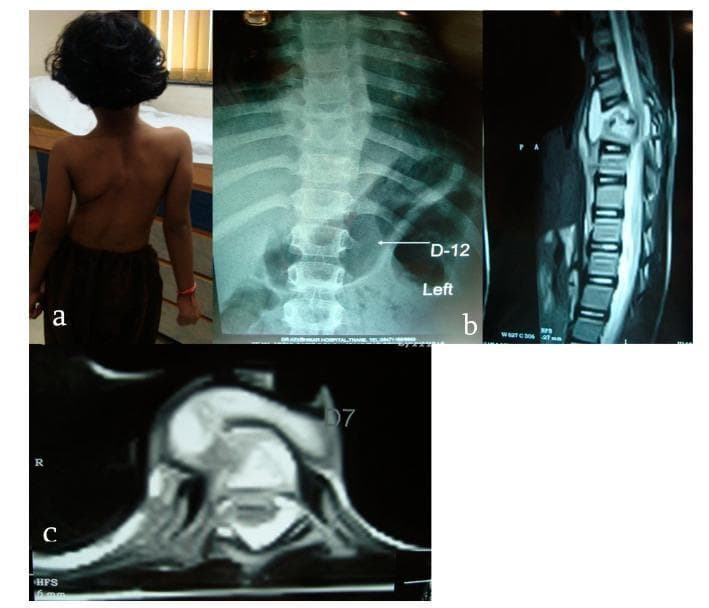 This composite figure illustrates a case of spinal tuberculosis (Pott's disease) in a pediatric patient through clinical photography, radiography, and MRI. Image (a) is a posterior clinical photograph of a 6-year-old girl showing significant lateral spinal curvature (scoliosis) and rib prominence. Image (b) is an anteroposterior X-ray of the dorsal spine demonstrating a collapse of the D8 vertebral body and a characteristic fusiform soft tissue shadow on the left side at the D12 level, suggestive of a paravertebral cold abscess. Image (c) consists of sagittal and axial MRI views of the dorsal spine. These scans reveal a wedge-shaped collapse of the D8 vertebral body with associated marrow edema and significant prevertebral and paravertebral fluid collections. There is evidence of subligamentous and epidural extension of the abscess, leading to spinal canal encroachment and compression of the neural elements. The findings are highly characteristic of granulomatous spinal infection, typically caused by Mycobacterium tuberculosis, highlighting the progression from vertebral destruction to deformity and potential neurological deficit.
