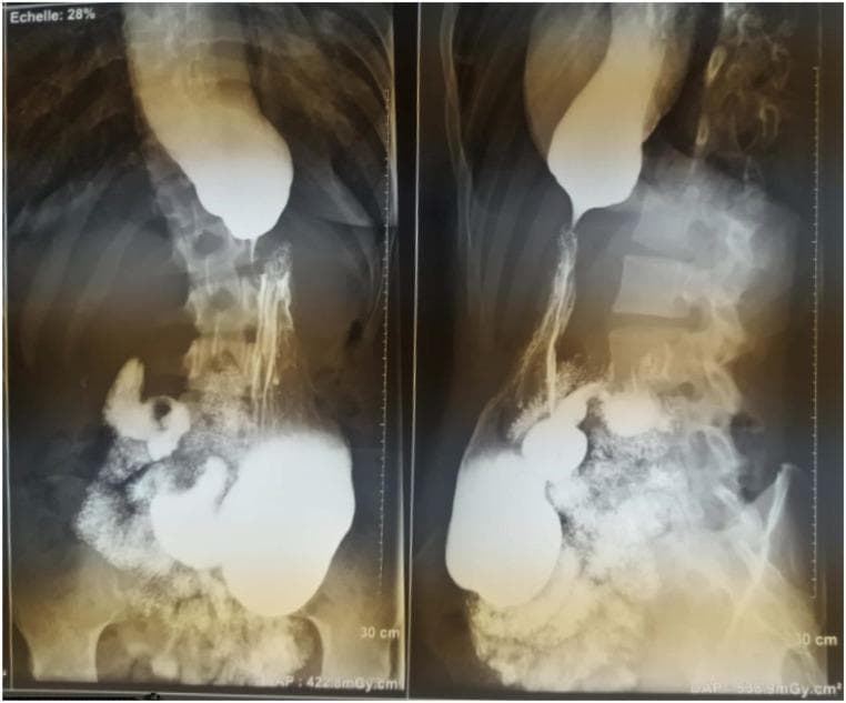 This diagnostic image consists of two views of a barium swallow x-ray radiography, showing the upper gastrointestinal tract in an anteroposterior and lateral perspective. The esophagus is markedly dilated (megaesophagus) with significant retention of the radiopaque barium contrast medium. At the gastroesophageal junction, there is a smooth, tapered narrowing of the distal esophagus, creating the classic 'bird's beak' appearance characteristic of achalasia. This narrowing represents the failure of the lower esophageal sphincter (LES) to relax. In the stomach, the barium presents a 'snowflake-falling' pattern, indicating irregular distribution and altered gastric filling. These findings are primary indicators of esophageal motility disorders, specifically achalasia, where the primary educational focus is on identifying the combination of proximal dilation and distal muscular obstruction at the cardia. This clinical imaging is essential for students and residents to recognize stages of Achalasia Cardia (AC) based on esophageal diameter and morphology.
