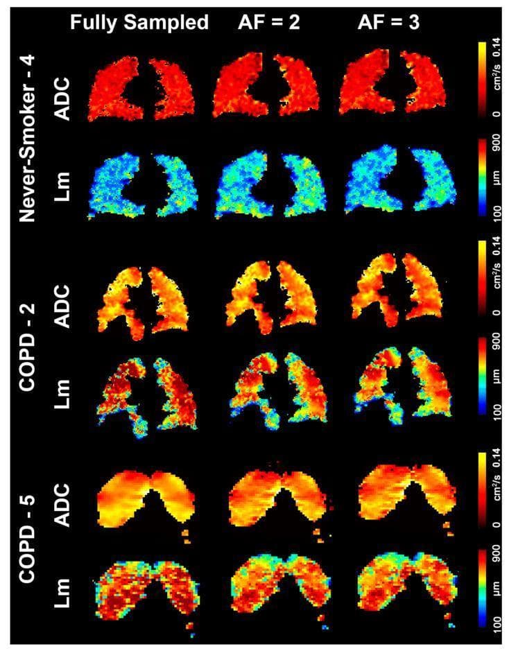 A comparison grid of 129Xe Magnetic Resonance Imaging (MRI) parametic maps showing coronal slices of human lungs. The grid compares three subjects—a healthy never-smoker, a patient with Chronic Obstructive Pulmonary Disease (COPD), and a patient with Alpha-1 Antitrypsin Deficiency (AATD/COPD)—across three data acquisition methods: Fully Sampled, Acceleration Factor (AF) = 2, and AF = 3. Two quantitative parameters are visualized: Apparent Diffusion Coefficient (ADC) and Mean Linear Intercept (Lm). The ADC maps (scale 0 to 0.14 cm²/s) show a progression from uniform low values (red) in the healthy subject to higher, more heterogeneous values (yellow/white) in COPD and AATD, indicating increased gas diffusivity due to alveolar wall destruction (emphysema). The Lm maps (scale 100 to 900 μm) show a shift from predominantly low values (blue/cyan) in the healthy lung to elevated, heterogeneous values (green/red) in the diseased lungs, representing alveolar enlargement. The image demonstrates that undersampled reconstructions (AF 2 and 3) maintain high qualitative and quantitative fidelity compared to fully sampled data in assessing obstructive lung disease.