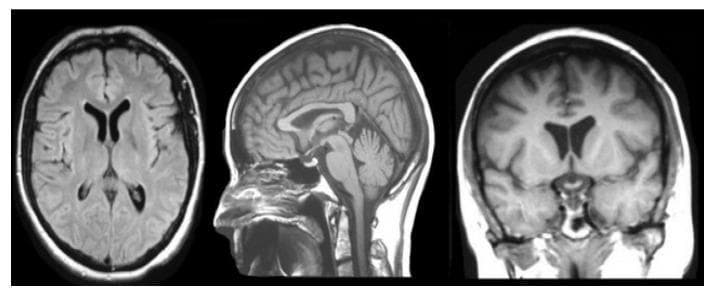 This diagnostic image provides a comprehensive anatomical overview of the human brain using magnetic resonance imaging (MRI) in three cardinal planes: axial, sagittal, and coronal. The axial view (left) demonstrates the symmetric cerebral hemispheres, gyri, sulci, and the butterfly-shaped lateral ventricles with dark signal intensity. The sagittal view (center) provides a midline perspective, clearly illustrating the C-shaped corpus callosum superior to the brainstem, the foliated structure of the cerebellum in the posterior fossa, and the vertical orientation of the brainstem and spinal cord. The coronal view (right) highlights the lateral ventricles and the slit-like third ventricle situated between the thalami, along with the vertical distribution of cerebral structures. These T1-weighted or FLAIR-like images emphasize tissue architectures, providing high-contrast detail between gray matter, white matter, and cerebrospinal fluid spaces. The visual is intended for neuroanatomical education and diagnostic training, focusing on spatial relationships and signal intensity variations in healthy brain tissue.
