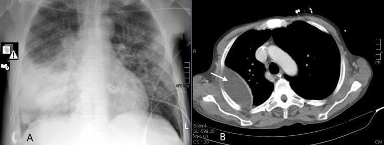 This dual-panel image displays diagnostic thoracic imaging from a patient with necrotizing pneumonia. Panel A is a posterior-anterior (PA) chest X-ray showing significant homogeneous opacity and consolidation in the middle and lower zones of the right lung, characteristic of lobar pneumonia. Normal lung markings are obscured on the right, while the left lung field shows more multifocal, patchy interstitial opacities. Panel B is a transverse (axial) contrast-enhanced CT scan of the thorax. A white arrow identifies a large, well-defined, peripherally located area of low attenuation in the posterior-lateral aspect of the right lung, representing a lung abscess. The lesion is lens-shaped, abuts the pleural surface, and exerts a mass effect on the adjacent pulmonary parenchyma. Central mediastinal structures, including the heart and great vessels, are visible and appear within normal limits. These images illustrate the progression of community-acquired pneumonia to necrotizing disease and abscess formation, a significant complication often associated with Streptococcus pneumoniae and SARS-CoV-2 coinfection.