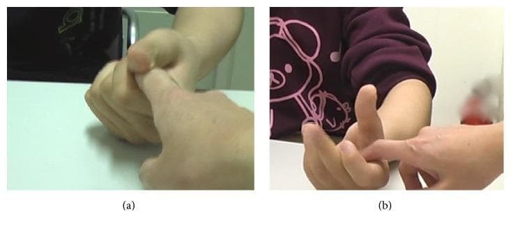 Two-panel clinical photograph demonstrating the evaluation of a grasp reflex in a pediatric patient with hemiplegia. Panel (a) illustrates the patient's hand in a forced, involuntary clenched fist position. An examiner's index finger is inserted into the palm, but the patient displays a pathological grasp reflex, showing an inability to inhibit the flexion or voluntarily open the hand to release the finger. Panel (b) shows the same clinical test after treatment with Botulinum Toxin Type A (BTX-A). In this frame, the patient demonstrates significant improvement in motor control; although the examiner's finger still provides a palmar stimulus, the patient is now able to voluntarily extend the fingers and open the hand. The comparison illustrates the reduction of spasticity and forced grasping following chemodenervation of the flexor muscles (including flexor digitorum superficialis and profundus), facilitating better functional movement and release capability in a neurorehabilitation context.