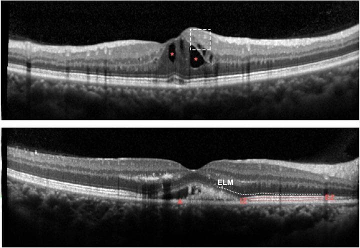 Two cross-sectional spectral-domain optical coherence tomography (SD-OCT) images of the human retina, illustrating characteristic findings in eyes with retinal vein occlusion (RVO) and macular edema. The upper panel demonstrates Disorganization of the Retinal Inner Layers (DRIL), indicated by a white dashed box, where the boundaries between the ganglion cell layer, inner plexiform layer, and inner nuclear layer are indistinguishable. Intraretinal fluid (IRF) is visible as hyporeflective cystoid spaces marked with red asterisks. The bottom panel highlights outer retinal damage, including subretinal fluid (SRF) appearing as a hyporeflective space beneath the neurosensory retina (red arrowhead) and disruption of the External Limiting Membrane (ELM), marked with a white dotted line. Additional labels indicate the Ellipsoid Zone (EZ) and Interdigitation Zone (IZ), highlighting areas of structural discontinuity in the photoreceptor layers. These biomarkers are critical in ophthalmology for assessing disease severity and predicting visual prognosis following anti-VEGF therapy.