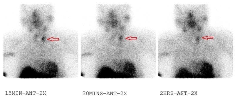 This diagnostic image set consists of three sequential parathyroid scintigraphy (Sestamibi scan) frames captured at 15-minute, 30-minute, and 2-hour intervals in the anterior projection. The imaging focuses on the neck and upper mediastinum to evaluate for parathyroid pathology. The series demonstrates a persistent, focal area of increased radiotracer uptake in the left parathyroid region, indicated by red horizontal arrows. While the physiological background activity in the salivary glands and thyroid tissue gradually washes out over the time course, the focal lesion on the left maintains high intensity, which is a classic diagnostic feature of a parathyroid adenoma. The scans also show expected physiological activity in the myocardium at the bottom of the frames. This comparison sequence is used in nuclear medicine to distinguish hyperfunctioning parathyroid tissue from thyroid tissue, as adenomas typically show delayed washout of technetium-99m methoxyisobutylisonitrile (Tc-99m MIBI) compared to the thyroid gland.