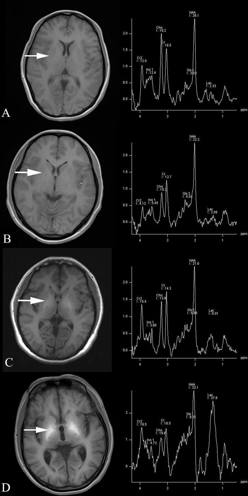 This diagnostic image set compares four axial T1-weighted MRI scans of the brain (A-D) with corresponding Magnetic Resonance Spectroscopy (MRS) plots. The sequence illustrates the progression of portal-systemic encephalopathy (PSE) in patients with chronic hepatic schistosomiasis japonicum (HSJ). In the T1-weighted images, a white arrow indicates the globus pallidus. As pathology progresses from a healthy control (A) to non-PSE (B), covert PSE (C), and overt PSE (D), there is a marked increase in bilateral globus pallidus hyperintensity, often associated with manganese deposition in hepatic failure. The corresponding MRS spectra, with a region of interest in the globus pallidus, demonstrate quantitative metabolic shifts: a progressive increase in glutamate/glutamine (Glx) and lactate (Lac) peaks, alongside a significant reduction in the myo-inositol (mI) peak. These neuroimaging biomarkers reflect osmotic adjustments and metabolic dysfunction characteristic of hepatic encephalopathy stages, providing a visual and biochemical correlation of disease severity.