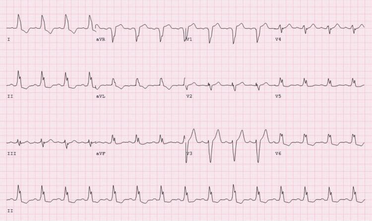 A 12-lead electrocardiogram (ECG) demonstrating classic features of Left Bundle Branch Block (LBBB). The rhythm is sinus tachycardia. The primary diagnostic finding is a widened QRS complex (>120 ms). In the precordial leads V1-V3, there is a predominantly negative QRS morphology consisting of deep, broad S-waves (QS or rS complexes) accompanied by discordant ST-segment elevation and upright T-waves. The lateral leads (I, aVL, V5, and V6) show broad, monophasic R-waves with characteristic slurring or notching at the peak. Leads I and aVL exhibit T-wave inversion and ST-segment depression, representing secondary repolarization abnormalities consistent with altered ventricular depolarization. This ECG was captured during a cardiac stress test following regadenoson administration, illustrating a rate-dependent or drug-induced conduction delay. It serves as a pedagogical example for recognizing LBBB morphology and distinguishing secondary ST-T wave changes from primary ischemic events in the presence of a bundle branch block.