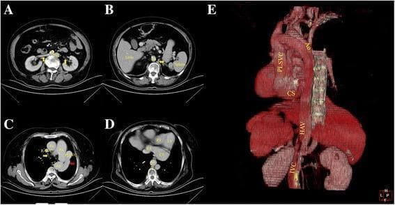 This composite figure contains axial contrast-enhanced CT scans (A-D) and a 3D reconstructive image (E) detailing complex congenital venous anomalies. The axial images show an interrupted left inferior vena cava (IVC) positioned posterolateral to the abdominal aorta, receiving drainage from bilateral renal veins. The IVC ascends and continues as an enlarged hemiazygos vein (HAV), which then progresses via the accessory hemiazygos vein into a persistent left superior vena cava (PLSVC). The PLSVC is shown draining into a significantly dilated coronary sinus (CS) within the left atrioventricular groove, which ultimately empties into the right atrium. Image C highlights a small azygos vein anterior to the vertebra crossing to the right superior vena cava (R-SVC), while image D demonstrates the massive coronary sinus. The 3D reconstruction (E) provides a comprehensive spatial overview of the anomalous pathway from the left IVC through the hemiazygos system and PLSVC to the heart, illustrating the anatomical relationship with the aorta and cardiac chambers.