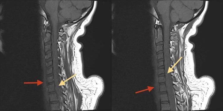 This diagnostic image consists of two side-by-side sagittal T1-weighted MRI scans of the cervical spine. The imaging demonstrates acute post-traumatic findings, specifically identifying prevertebral and intraspinal hemorrhage. Red arrows point to a prevertebral hematoma, visualized as a region of slight hyperintensity in the prevertebral soft tissues anterior to the C5-T1 vertebral bodies. Yellow arrows indicate an intraspinal epidural hematoma, which appears as a hyperintense signal within the spinal canal, posterior to the vertebral bodies, causing mass effect and moderate compression of the cervical spinal cord. The anatomical region spans the lower cervical and upper thoracic levels. These features are characteristic of acute whiplash or high-energy trauma, highlighting the risk of multi-compartment bleeding. This content is intended for intermediate to advanced medical education, focusing on neuroradiology and emergency trauma assessment of spinal cord compression and ligamentous injury.