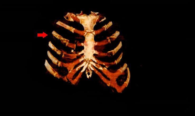 This diagnostic image is a three-dimensional (3D) reconstruction of a chest CT scan, providing a detailed anterior view of the thoracic cage. The image highlights the skeletal anatomy including the sternum and bilateral ribs. A red arrow indicates pathology on the right side of the chest at the level of the third rib. The reconstruction reveals multiple traumatic injuries characterized by costochondral dislocations and fractures. Specifically, there is a visible disruption and misalignment at the costochondral junctions of the right third, fourth, and fifth ribs. These lesions demonstrate a loss of continuity between the osseous portion of the ribs and their corresponding costal cartilages that normally articulate with the sternum. The sternal body remains largely intact, but the significant displacement of the anterior rib segments indicates severe blunt force trauma. This visual serves as an educational tool for identifying chest wall instability and distinguishing costochondral separation from simple rib fractures in a clinical trauma setting.