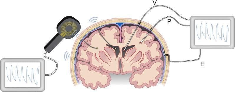 This medical anatomical diagram illustrates the various invasive methods and anatomical locations for monitoring intracranial pressure (ICP) in the human brain. The illustration highlights three primary wired sensor placements: intraventricular (V), where a catheter is placed within the cerebral ventricles; intraparenchymal (P), with a sensor implanted directly into the brain tissue; and epidural (E), where the sensor is positioned between the skull and the dura mater. These sensors are shown connected via physical wires to an external monitor displaying pulsatile ICP waveforms. Additionally, the diagram compares these traditional wired methods with wireless telemetric systems. On the left, implantable sensors in the ventricular or parenchymal spaces communicate via radiofrequency signals with an external receiver held against the scalp, which then transmits data to a digital monitor. This visualization demonstrates the technical evolution from wired catheter-based monitoring to wireless, minimally invasive telemetric technologies used in neurocritical care for managing conditions like hydrocephalus, traumatic brain injury, and subarachnoid hemorrhage.