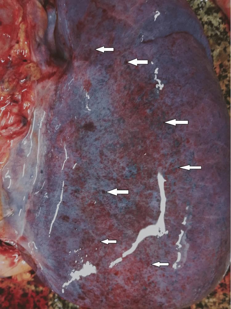 This clinical photograph shows a gross pathological view of a human lung during a postmortem examination. The pleural surface exhibits severe congestion and is notable for extensive sub-pleural hemorrhages. These hemorrhages are primarily petechial or dot-like in morphology, measuring approximately 2-3 mm in diameter. Several white arrows highlight areas where these dark reddish to purplish lesions are densely distributed. In multiple regions, the individual petechiae have coalesced or merged, forming larger, irregular ecchymotic patches. The overall lung tissue appears mottled and edematous, consistent with systemic pathology such as severe infection, sepsis, or asphyxiation. This image serves as a significant educational reference for forensic and clinical pathology, illustrating the classic appearance of visceral sub-pleural hemorrhages (Tardieu spots) and profound pulmonary congestion.