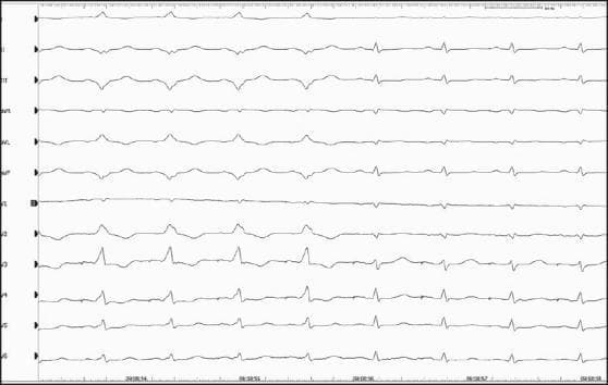 This diagnostic image is a 12-lead electrocardiogram (ECG) demonstrating the successful intraprocedural catheter ablation of an accessory pathway in a patient with Wolff-Parkinson-White (WPW) syndrome. The recording captures a transition between two distinct conduction states. The first four cardiac cycles exhibit classic pre-excitation features: a shortened PR interval and widened, slurred QRS complexes (delta waves) most prominent in leads V2-V5 and the inferior leads, indicating anterograde conduction across an accessory pathway. Following these beats, the subsequent four cycles show an immediate normalization of cardiac conduction post-ablation. These latter beats demonstrate a physiological PR interval and narrow, crisp QRS complexes, signifying that ventricular activation is occurring solely through the normal atrioventricular (AV) node-His-Purkinje system. This comparison serves as a definitive visual confirmation of the elimination of the bypass tract, which in this clinical context was associated with a high risk of malignant arrhythmias.