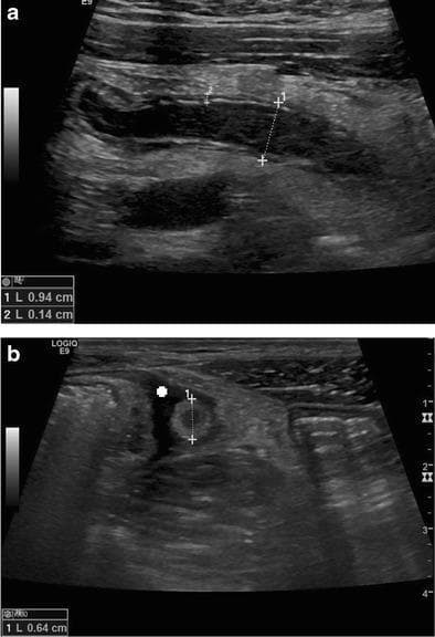 Educational diagnostic ultrasound images demonstrating acute appendicitis in longitudinal (a) and transverse (b) planes. Image (a) shows a longitudinal view of a distended, non-compressible appendix with an anteroposterior diameter of 0.94 cm and mural thickening of 0.14 cm. Hypoechoic free fluid is visible surrounding the structure. Image (b) shows the appendix in a transverse cross-section, displaying the classic 'target sign' (bull’s eye appearance), characterized by alternating hyperechoic and hypoechoic concentric rings representing the fluid-filled lumen, mucosa/submucosa, and muscularis layers. The transverse diameter is measured at 0.64 cm. These findings—specifically a total diameter greater than 6 mm, wall thickening, and periappendiceal fluid—are key diagnostic ultrasound criteria for acute appendicitis. The images serve as an educational example of graded-compression sonography for gastrointestinal pathology.
