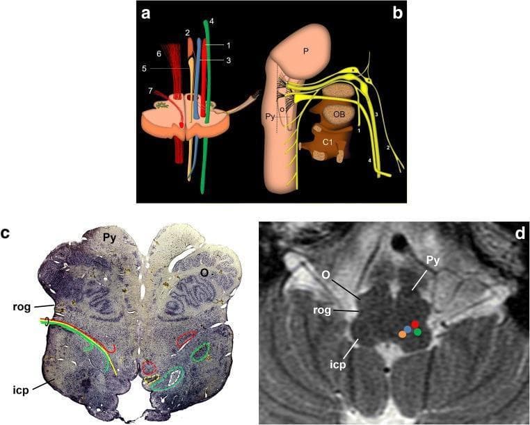 Educational panel illustrating the anatomy of the glossopharyngeal nerve (CN IX) and its relationships in the medulla oblongata. Figure (a) is an anatomical diagram of a transverse section of the medulla at the level of the inferior olive, highlighting efferent nuclei—nucleus ambiguus (1) and inferior salivatory nucleus (2)—and afferent nuclei—solitary nucleus (3) and spinal trigeminal nucleus (4). Other shown structures include the dorsal motor nucleus of vagus (5), pyramidal tract (6), and hypoglossal nerve (7). Figure (b) is a schematic drawing of the lower cranial nerves (1: spinal, 2: CN IX, 3: vagus, 4: hypoglossal) showing their course from the brainstem to the jugular foramen in relation to the pons (P), pyramid (Py), and occipital bone (OB). Figures (c) and (d) provide clinical correlation via a Nissl-stained micrographic slice and an axial T2-weighted MRI, respectively. These images demonstrate the retro-olivary groove (rog), inferior olivary nucleus (O), and inferior cerebellar peduncle (icp), identifying the precise exit point and internal nuclear organization of the glossopharyngeal nerve within the upper medulla.