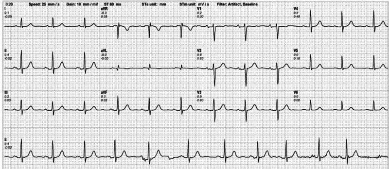 A standard 12-lead diagnostic resting electrocardiogram (ECG) displayed on a grid. The tracing includes the standard limb leads (I, II, III), augmented limb leads (aVR, aVL, aVF), and precordial leads (V1-V6), with a long rhythm strip of lead II at the bottom. The visual demonstrates a normal sinus rhythm characterized by consistent P-wave morphology preceding every QRS complex, regular R-R intervals, and a heart rate within normal physiological limits (approximately 80-85 bpm). Waveform analysis shows normal axis, absence of ST-segment elevation or depression, and normal T-wave morphology across all leads, indicating no acute ischemic changes at rest. Technical parameters visible at the top specify a paper speed of 25 mm/s, a gain (voltage scale) of 10 mm/mV, and the application of artifact and baseline filters. This diagnostic image serves as a baseline comparison for clinical cardiac assessment and the evaluation of coronary artery disease.