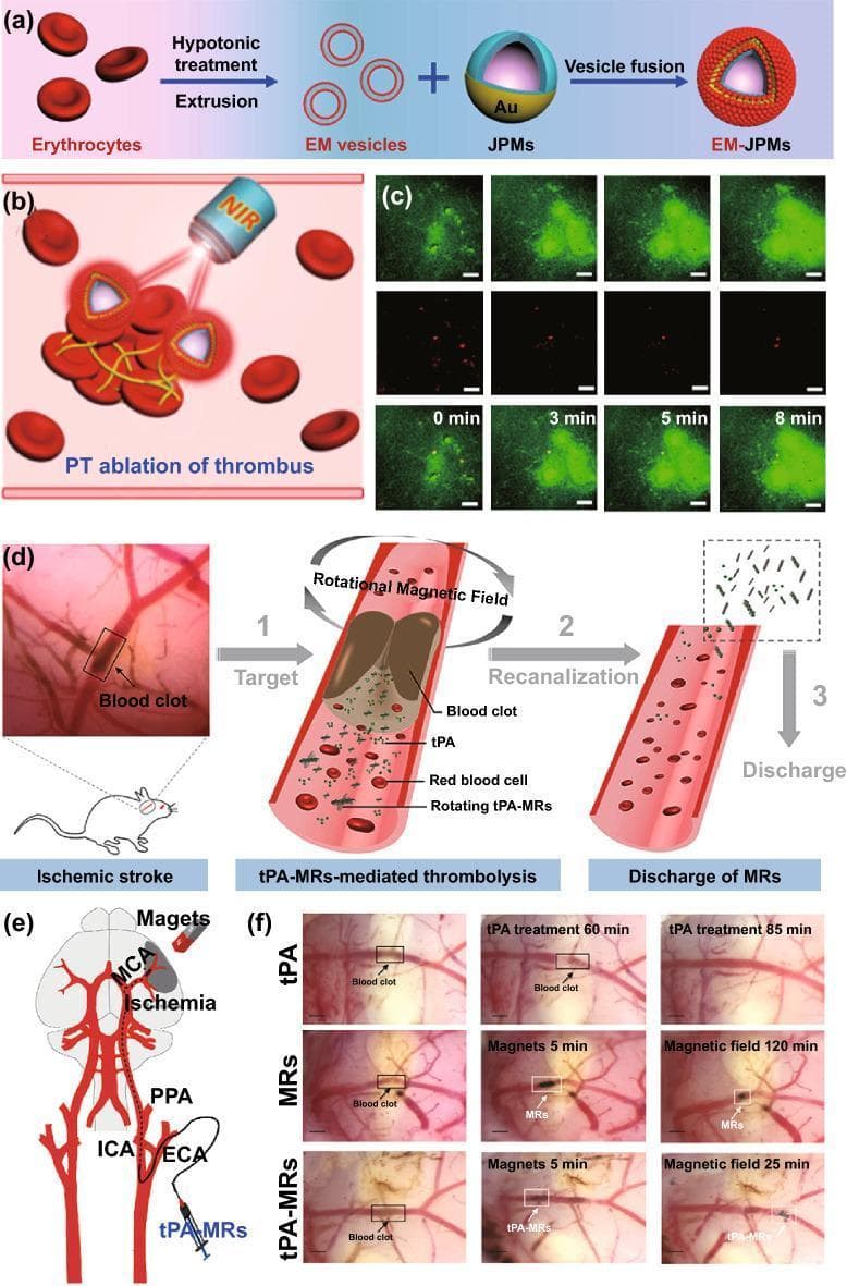 This multi-panel figure illustrates advanced nanomedicine strategies for thrombolysis (blood clot dissolution). (a) Schematic of Erythrocyte Membrane-coated Janus Polymeric Motors (EM-JPMs) preparation via hypotonic treatment, extrusion into EM vesicles, and fusion with gold-capped Janus motors. (b) Diagram of photothermal (PT) ablation using Near-Infrared (NIR) laser targeting a thrombus. (c) Time-lapsed Two-Photon Confocal Laser Scanning Microscopy (TP-CLSM) fluorescence images (0-8 min) demonstrating thrombus reduction following PT ablation. (d) Three-step schematic of magnetic field-responsive thrombolysis: 1. Targeting the clot; 2. Recanalization through rotational magnetic field-driven tPA-Microrods (tPA-MRs); 3. Discharge of fragmented materials. (e) Anatomical diagram of a cranial arterial tree (ICA, ECA, MCA, PPA) showing magnetic guidance of tPA-MRs to an ischemic MCA region. (f) Optical Coherence Tomography (OCT) clinical images comparing thrombolytic efficacy of tPA alone, MRs alone, and tPA-MRs under a rotational magnetic field, with the latter showing rapid, significant recanalization by 25 minutes. The figure highlights the integration of nanotechnology, magnetic guidance, and photothermal therapy in treating ischemic stroke and vascular thrombosis.
