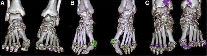 This diagnostic image set consists of three dual-energy computed tomography (DECT) reconstructions (labeled A, B, and C) of human feet, demonstrating monosodium urate (MSU) crystal deposition characteristic of gout. The 3D reconstructions use color-coding to highlight soft tissue uric acid deposits against the skeletal structure. Panel A illustrates a small deposit volume (0.17 cm³), with localized purple indicators near the phalanges and tarsal regions. Panel B shows a larger deposit load (5.29 cm³), with prominent green clusters primarily located at the first metatarsophalangeal (MTP) joints, representing significant tophi. Panel C displays a cutoff volume (0.81 cm³), showing intermediate distribution across the midfoot and toes. This image set is used in rheumatology to visualize tophaceous burden and assess the risk of clinical flares. The anatomical focus includes the tarsals, metatarsals, and phalanges, highlighting the predilection of MSU crystals for peripheral joints. These visualizations provide a non-invasive method for quantifying total urate burden that may not be apparent on standard radiography.