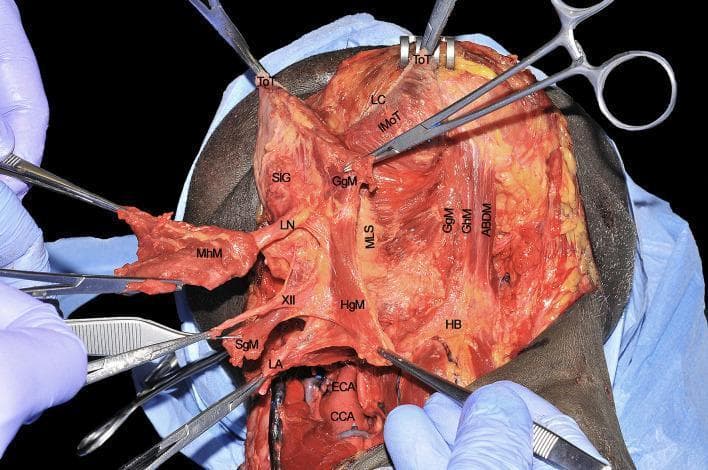 A clinical photograph of a cadaveric dissection illustrating the deep surgical anatomy of the tongue and submandibular region, relevant to compartmental surgery. The image shows several extrinsic tongue muscles and neurovascular structures held with surgical instruments to demonstrate spatial relationships. Key anatomical landmarks labeled include the hyoglossus muscle (HgM), genioglossus muscle (GgM), and mylohyoid muscle (MhM). The hypoglossal nerve (XII) is shown running superficial to the hyoglossus muscle, while the lingual artery (LA) is positioned deep to it. The lingual nerve (LN) is visible in proximity to the sublingual gland (SlG) and retracted mylohyoid muscle. Other identified structures include the common carotid artery (CCA), external carotid artery (ECA), styloglossus muscle (SgM), hyoid bone (HB), and the median lingual septum (MLS). This visual facilitates the understanding of tumor spread pathways (T-N tract) along muscular and neurovascular bundles in head and neck oncology.